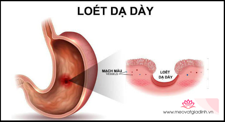 Cải thiện tình trạng loét dạ dày