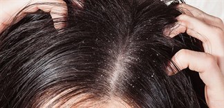 Tại sao mùa đông da đầu lại có nhiều gàu hơn?
