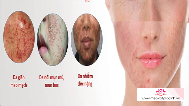 Một số dấu hiệu xuất hiện trên da khi sử dụng mỹ phẩm chứa corticoid