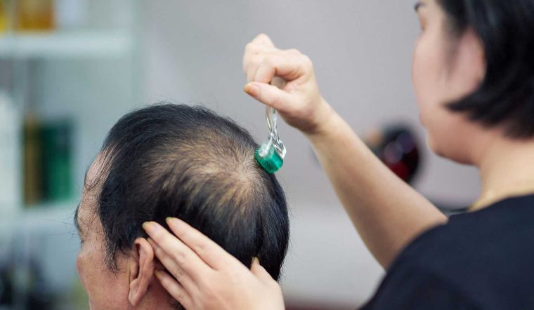 Bạn có biết lăn kim tại nhà có thể giúp trị hói, giảm tình trạng tóc mọc thưa?