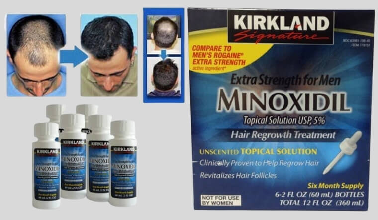 Minoxidil là gì? Sử dụng như thế nào trong điều trị rụng tóc?