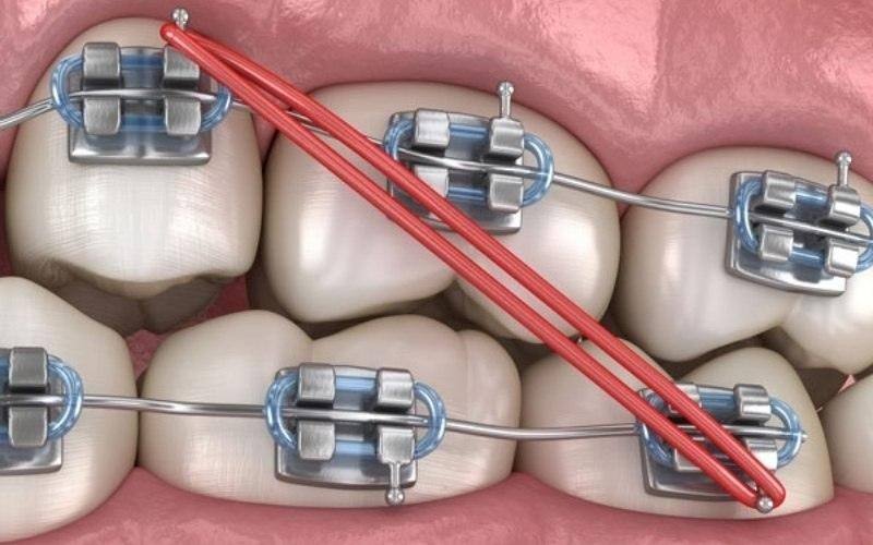 Tác dụng của thun liên hàm khi niềng răng