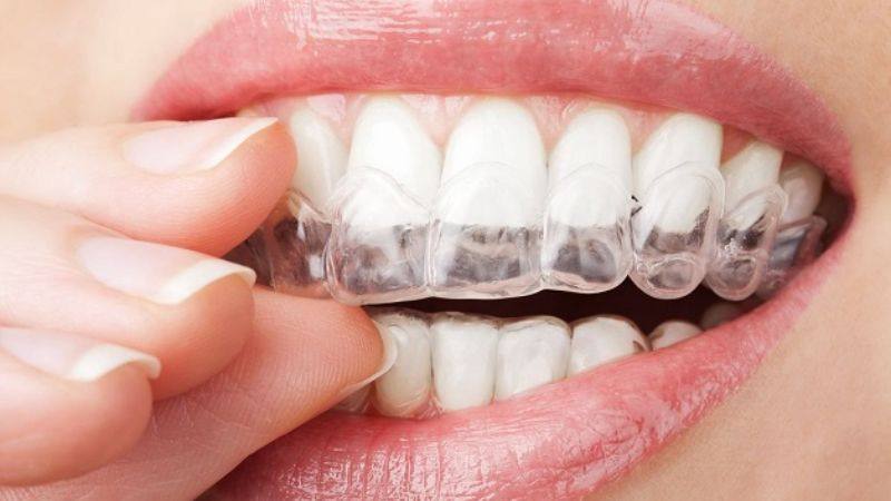 Niềng răng trong suốt Invisalign