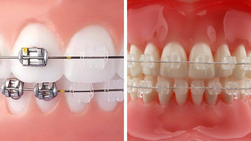 Hiệu quả của niềng răng mắc cài sứ thường và niềng răng mắc cài sứ tự buộc