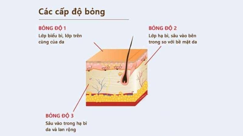 Các mức độ tổn thương khi bé bị bỏng sữa