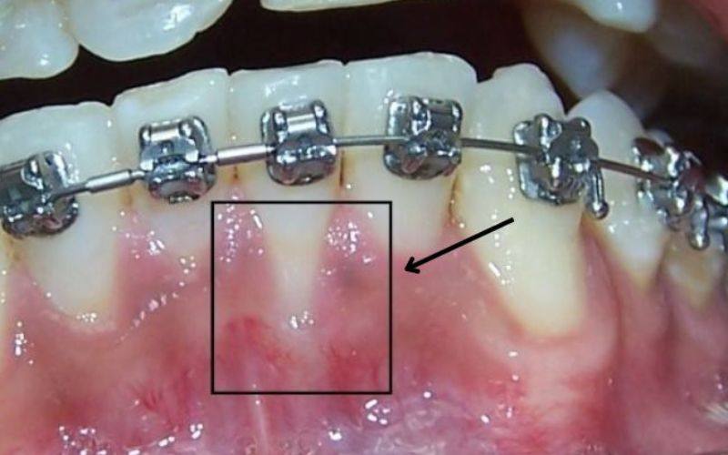 Tụt lợi khi niềng răng là gì?