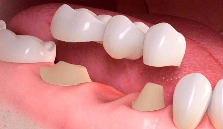 Mão răng sứ là gì? Các loại mão răng sứ hiện nay