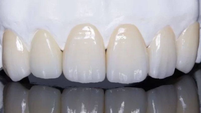 Bọc răng sứ cho 2 răng cửa có đau không?