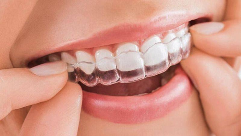 Niềng mắc cài trong suốt Invisalign