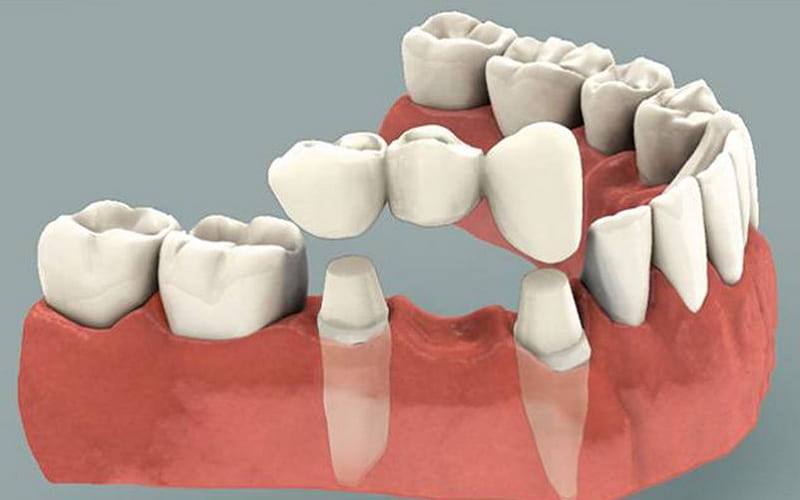 Tháo lắp răng sứ nhiều lần có gây ảnh hưởng gì không?