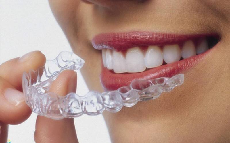 Niềng răng không mắc cài Invisalign